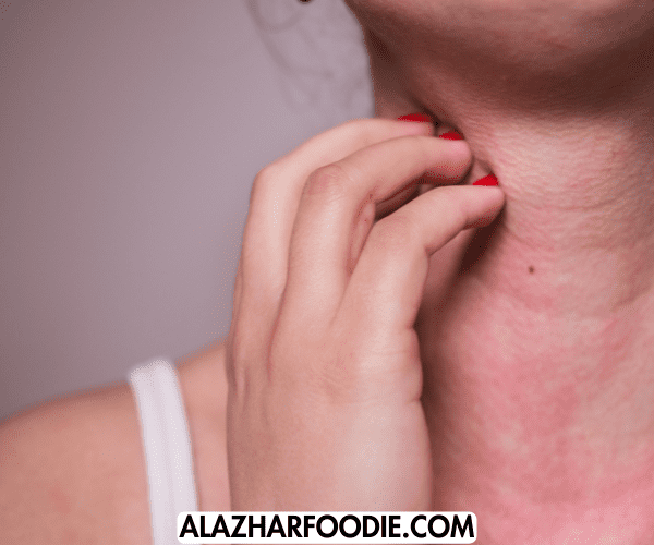 Allergy Reactions